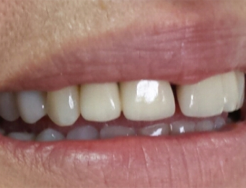 Επανορθωτικη οδοντιατρική-Στεφάνες ζιρκονίου